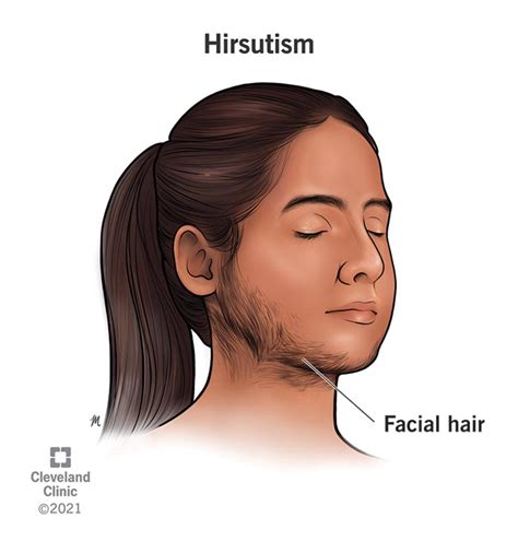 hirsuit|Hirsutism in Women .